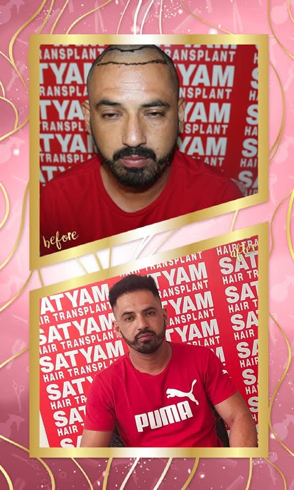 A powerful before and after hair transplant result from Satyam Hair Transplant Centre. The 'before' shows the precisely drawn hairline on the shaved scalp pre-op, and the 'after' shows a full, dense, and naturally restored head of hair with a modern, clean style.