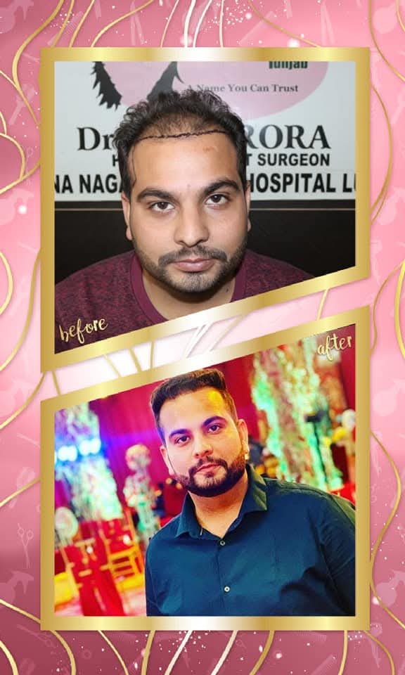 The 'before' shows the hairline drawn for restoration on existing thinning hair, and the 'after' shows a full, dense, and naturally restored head of hair with a modern style.