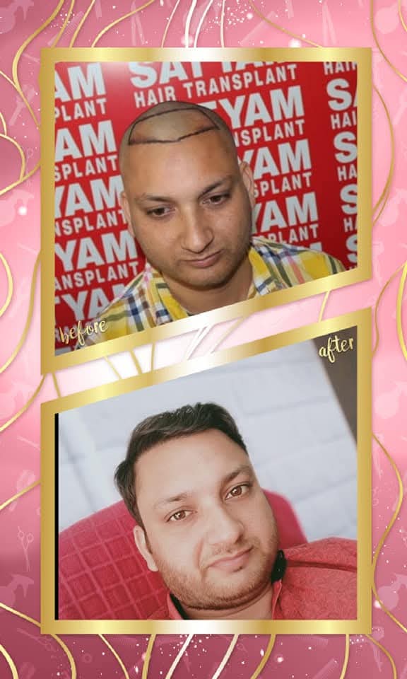 A successful before and after hair transplant result for a male patient from Satyam Hair Transplant Centre. The 'before' shows the precisely drawn hairline on the shaved scalp pre-op, and the 'after' shows a full, dense, and naturally restored head of hair.