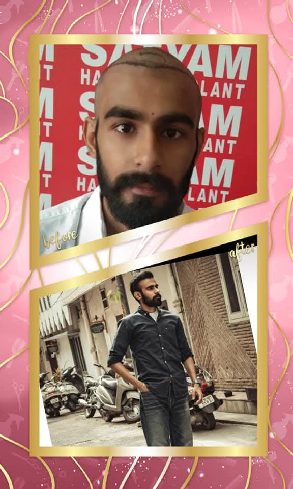 A powerful before and after hair transplant result from Satyam Hair Transplant Centre. The 'before' shows the precisely drawn hairline on the shaved scalp pre-op, and the 'after' shows a full, dense, and naturally restored head of hair with a modern, confident style.