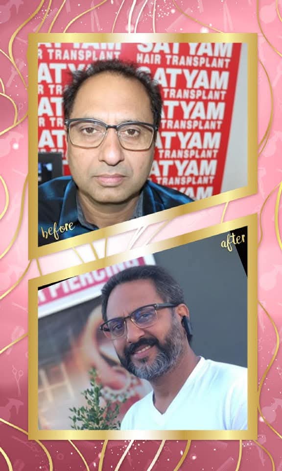 Exceptional before and after hair transplant result for a male patient from Satyam Hair Transplant Centre. The 'before' shows frontal hair thinning and recession, and the 'after' shows a full, dense, and naturally restored hairline with a happy, confident smile.