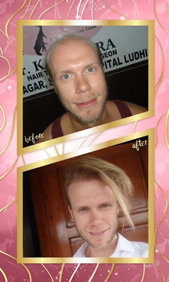 successful hair transplant result on a Caucasian male patient by Dr. K.K. Arora, Surgeon, Hospital Ludhiana. The 'before' shows frontal balding, and the 'after' shows a complete, natural-looking restoration with long, styled blonde hair.