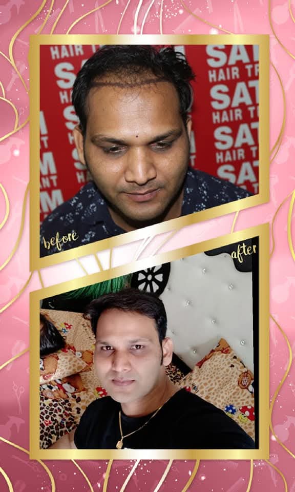 A successful before and after hair transplant result for a male patient from Satyam Hair Transplant Centre. The 'before' shows frontal thinning and the recipient area marked, and the 'after' shows a full, dense, and naturally restored head of hair.