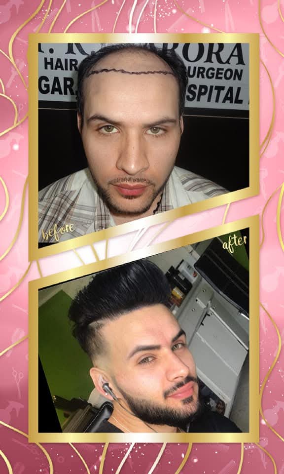 The 'before' shows the precisely drawn hairline on the shaved scalp, and the 'after' shows an exceptional, dense, and sharply styled hair restoration.