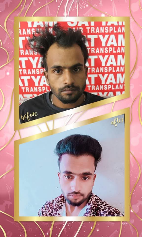 Impressive before and after hair transplant result on a male patient from Satyam Hair Transplant Centre. The 'before' shows frontal hair loss and recession, and the 'after' shows a full, dense, and perfectly restored hairline and hair volume.