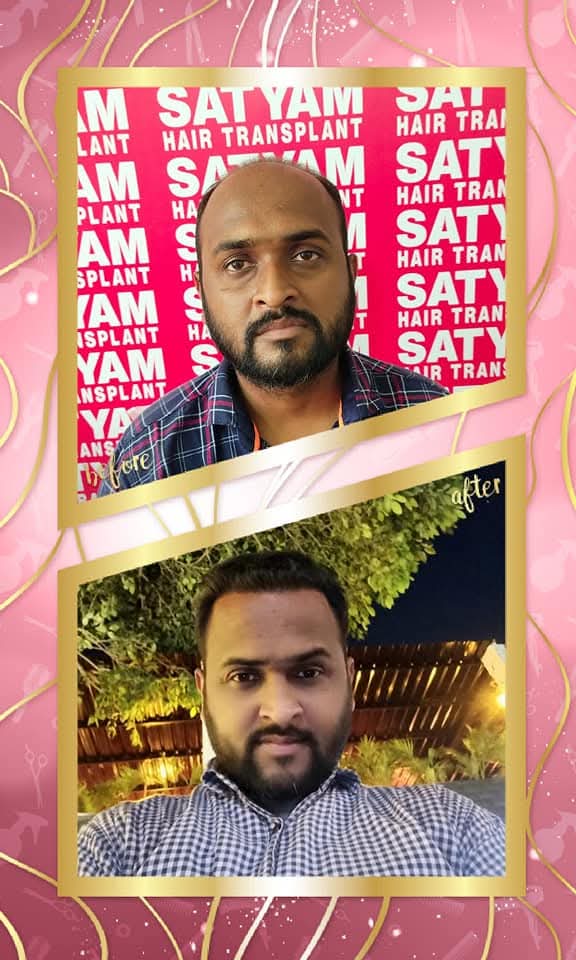 A successful before and after hair transplant result for a male patient from Satyam Hair Transplant Centre. The 'before' shows extensive balding across the frontal and crown areas, and the 'after' shows a full, dense, and naturally restored head of hair.