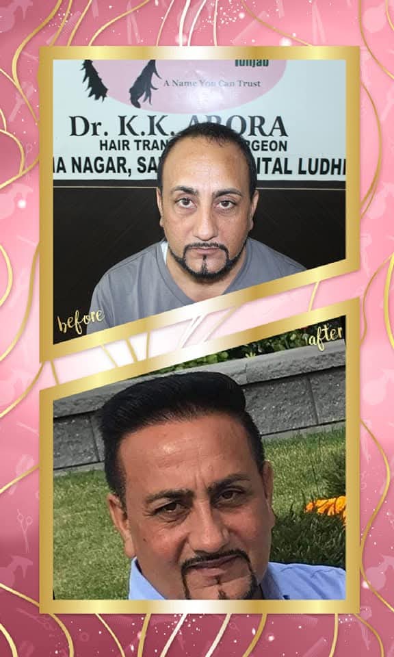 A fantastic before and after hair transplant result by Dr. K.K. Arora, Surgeon, Hospital Ludhiana. The 'before' shows frontal balding, and the 'after' shows a complete, dense hair restoration with a modern, voluminous style.
