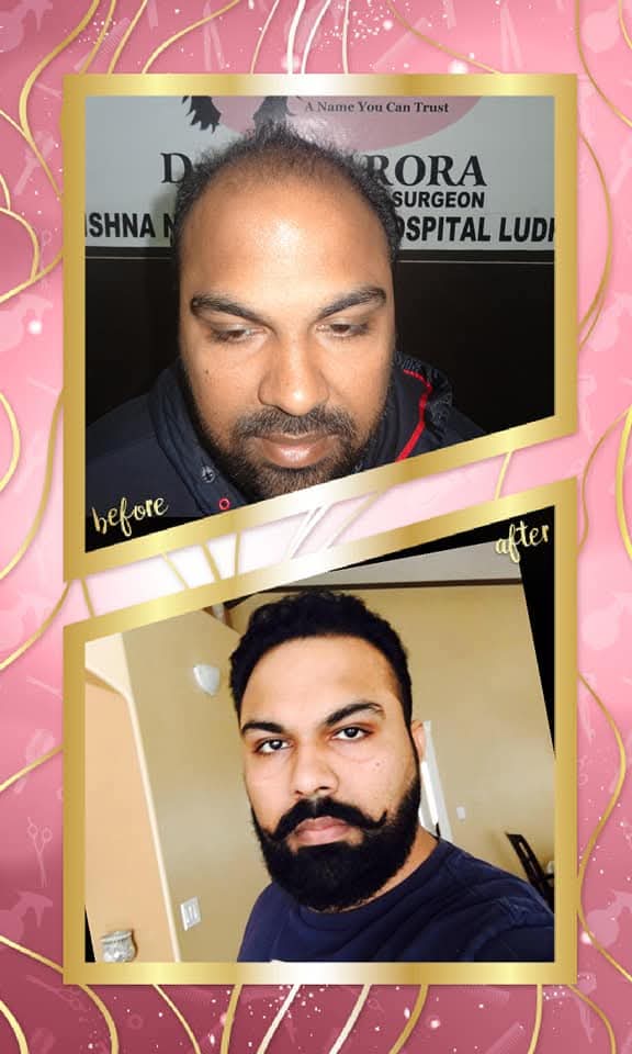 A remarkable before and after hair transplant result. The 'before' shows significant balding on the crown, and the 'after' shows a full, dense, and perfectly restored head of hair.