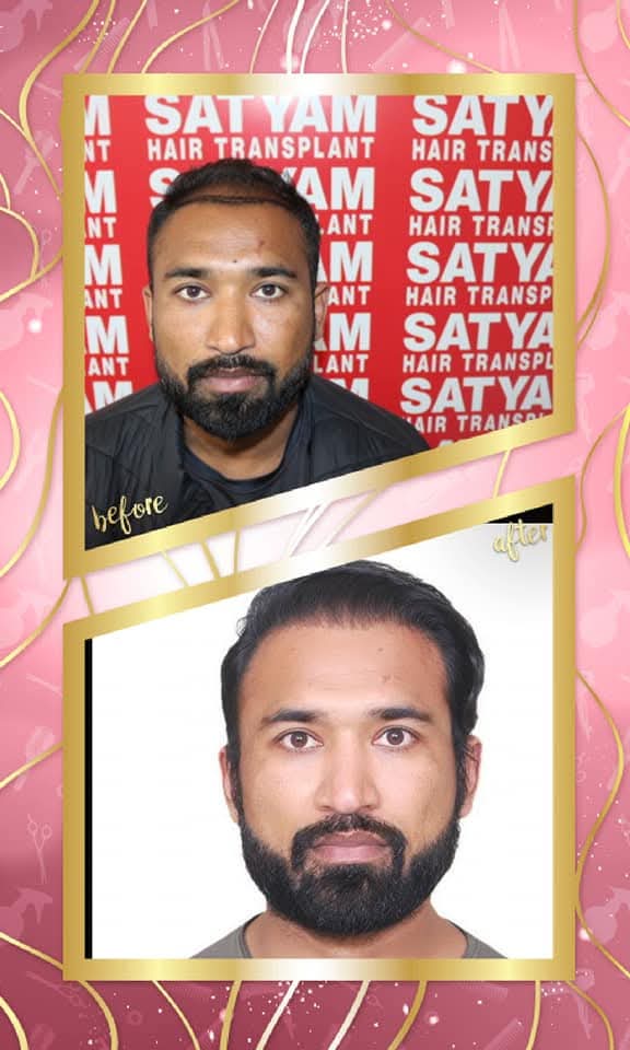 A fantastic before and after hair transplant result on a male patient from Satyam Hair Transplant Centre. The 'before' shows frontal thinning and recession, and the 'after' shows a full, dense, and naturally restored hairline and hair growth.