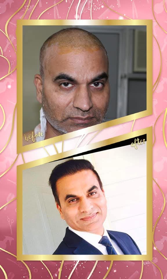 A dramatic before and after hair transplant result on an older male patient. The 'before' shows the patient immediately post-surgery with a shaved head and bandages, and the 'after' shows a complete rejuvenation with a full, dense, and naturally styled head of hair.