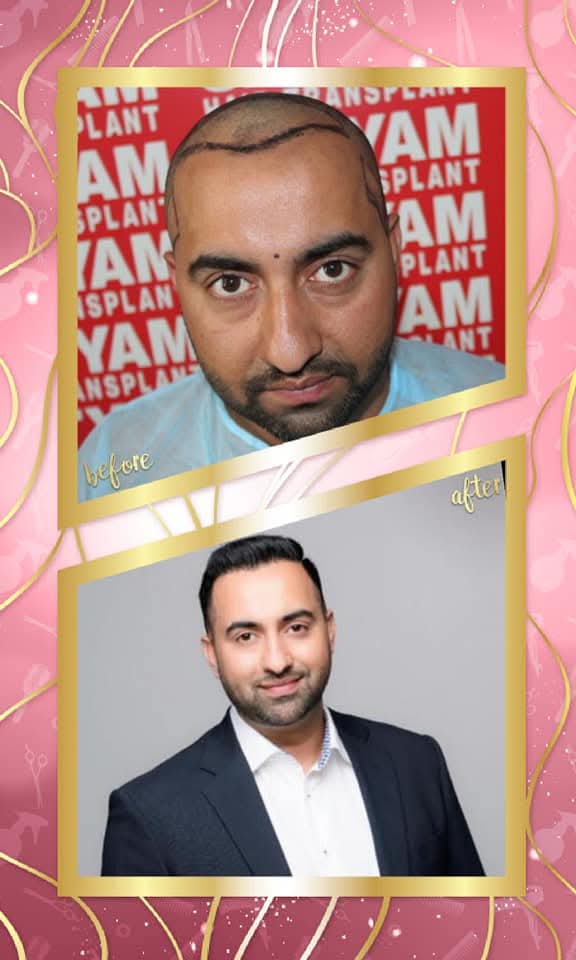 Professional before and after hair transplant result from Satyam Hair Transplant Centre. The 'before' shows the patient's pre-operative state with the hairline marked on the shaved scalp, and the 'after' shows a full, dense, and professionally styled hair restoration.