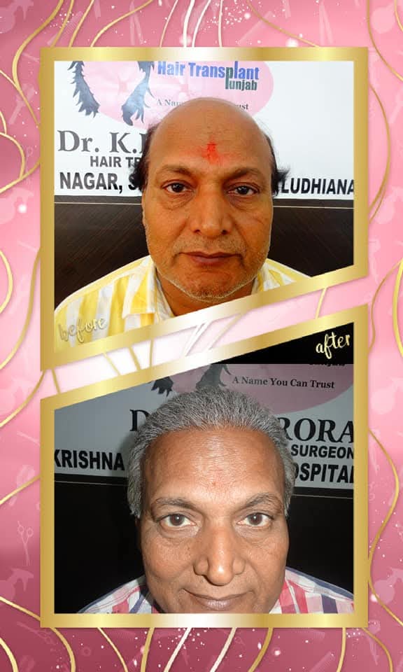 Successful before and after hair transplant on a mature male patient by Dr. K.K. Arora in Ludhiana, Punjab. The 'before' shows extensive frontal balding, and the 'after' shows a complete, natural-looking restoration of the hairline with dense gray hair.