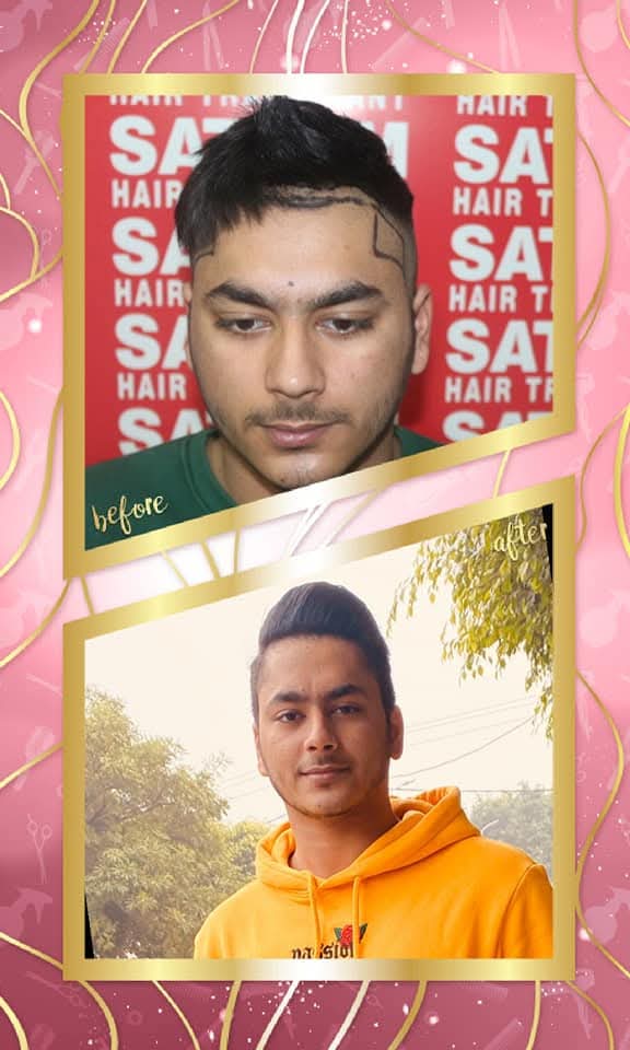 Excellent before and after hair transplant result on a young male patient from Satyam Hair Transplant Centre. The 'before' shows the planned hairline drawn on the scalp with existing hair, and the 'after' shows a dense, fully restored, and stylish hairline.