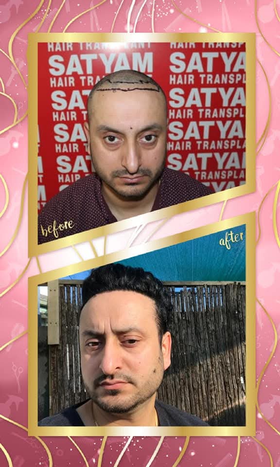 A powerful before and after hair transplant result from Satyam Hair Transplant Centre. The 'before' shows the patient's scalp shaved and the new hairline drawn, and the 'after' shows dense, natural hair growth with a completely restored hairline.