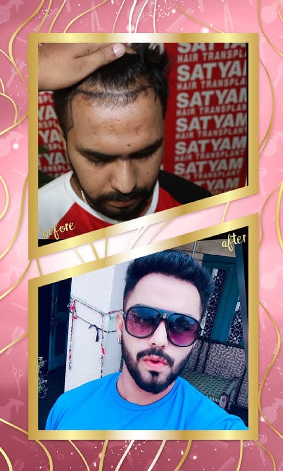 Outstanding before and after hair transplant result from Satyam Hair Transplant Centre. The 'before' shows the patient's hairline marked for transplantation, and the 'after' shows a full, perfectly dense, and stylishly restored hairline and hair.