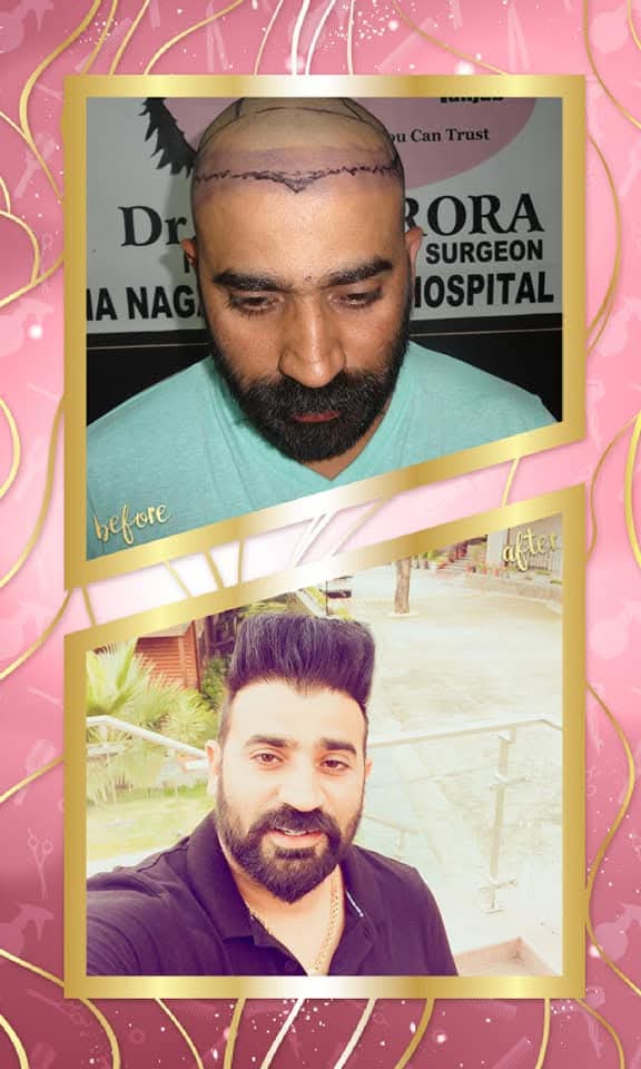 Successful before and after hair transplant result on a male patient from Dr. Arora Surgeon Hospital (or clinic), showing the head shaved and hairline marked pre-surgery, followed by a complete transformation with dense, stylish hair growth.