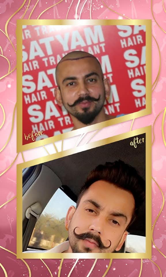 A dramatic before and after hair transplant result for a male patient from Satyam Hair Transplant Centre. The 'before' shows the precisely drawn hairline on the shaved scalp pre-op, and the 'after' shows a full, dense, and naturally restored head of hair with a stylish pompadour.
