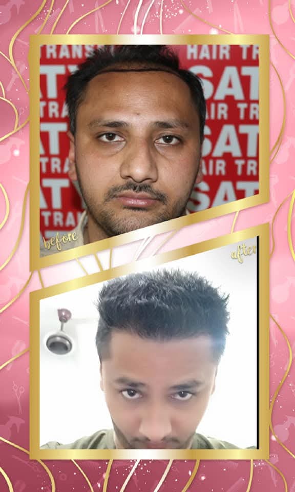 An exceptional before and after hair transplant result from Satyam Hair Transplant Centre. The 'before' shows the patient's partially shaved scalp with the new hairline drawn, and the 'after' shows a full, dense, and naturally restored head of hair.