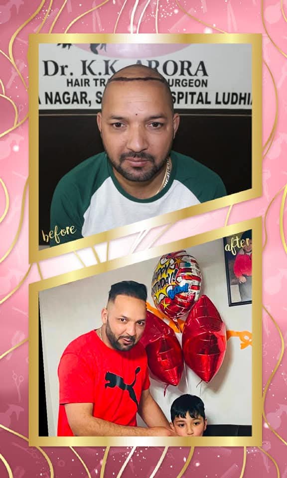 A life-changing hair transplant result from Dr. K.K. Arora, Surgeon, Hospital Ludhiana. The 'before' shows the hairline marked on the shaved scalp, and the 'after' shows a complete, dense hair restoration.