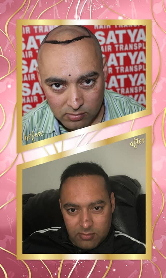 Excellent before and after hair transplant result for a male patient from Satyam Hair Transplant Centre. The 'before' shows the precisely drawn hairline on the shaved scalp pre-op, and the 'after' shows a full, dense, and naturally restored head of hair.