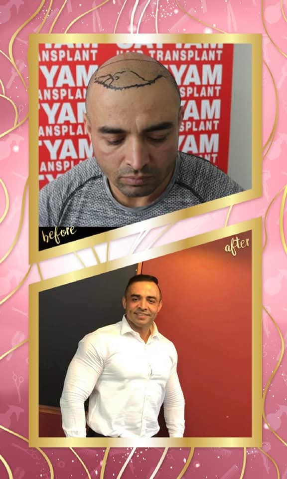 High-impact before and after hair transplant result from Satyam Hair Transplant Centre. The 'before' shows the patient's head shaved with the new aggressive hairline meticulously drawn, and the 'after' shows a complete, dense, and confident hair restoration.