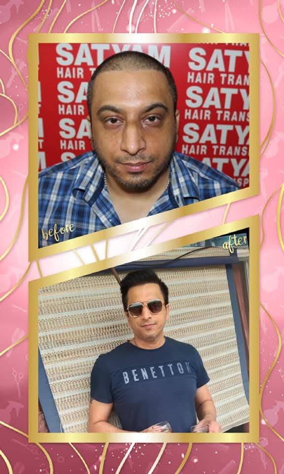 Impressive before and after hair transplant result on a male patient from Satyam Hair Transplant Centre. The 'before' shows a partially shaved scalp with the new hairline drawn, and the 'after' shows a dense, stylish, and full head of hair with a rejuvenated appearance.