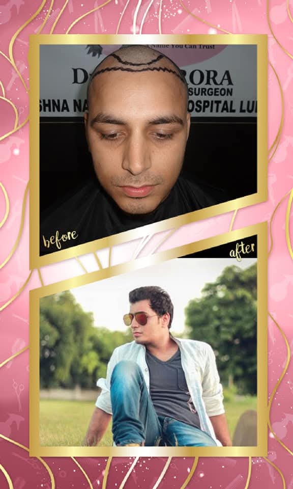 Before and after hair transplant result showing the pre-operative stage with the hairline marked and the final result with a full, dense, and naturally styled head of hair.