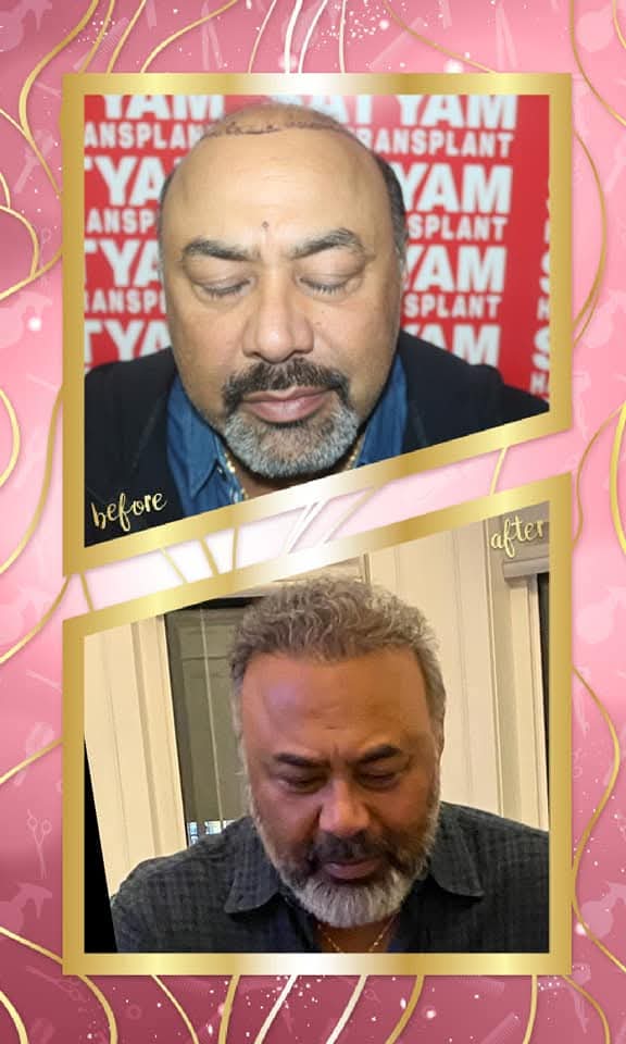 A phenomenal before and after hair transplant result for a mature male patient from Satyam Hair Transplant Centre. The 'before' shows the shaved scalp and drawn hairline, and the 'after' shows the successful, dense restoration of natural gray/salt-and-pepper hair.