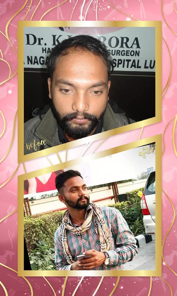 A dramatic before and after result of a successful hair transplant performed by Dr. K.K. Arora, Hair Transplant Surgeon, at Satyam Hair Transplant Centre. The 'before' shows frontal baldness, and the 'after' shows dense hair, a new style, and a confident look.