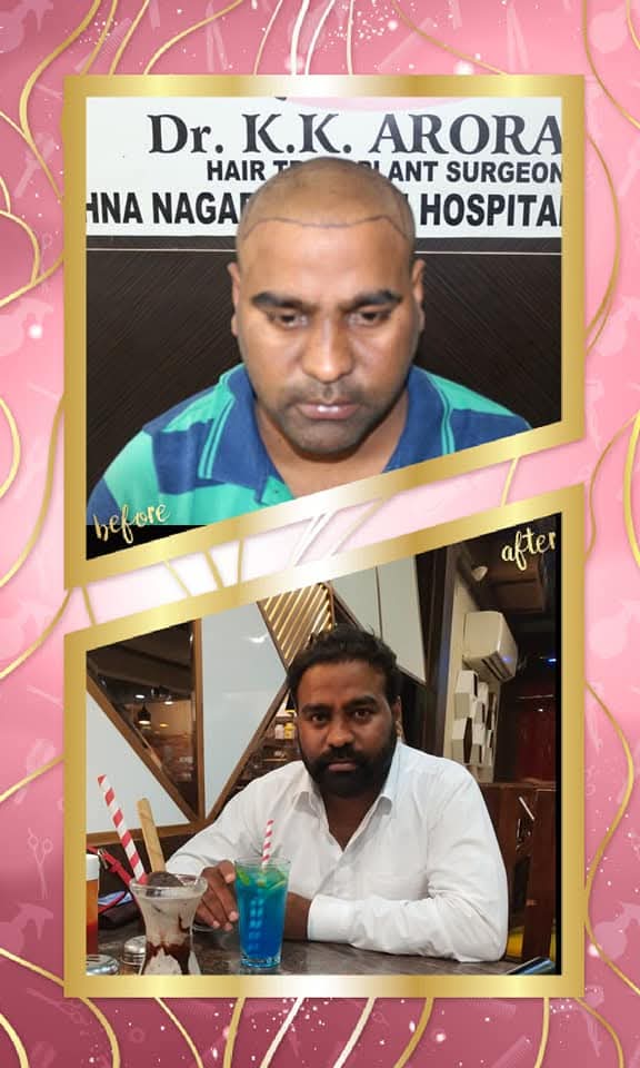 Before and after hair transplant result for a male patient from Dr. K.K. Arora Hair Transplant Surgeon Hospital. The 'before' image shows the shaved scalp with the new hairline drawn, and the 'after' shows the patient with full, natural-looking hair in a casual setting.