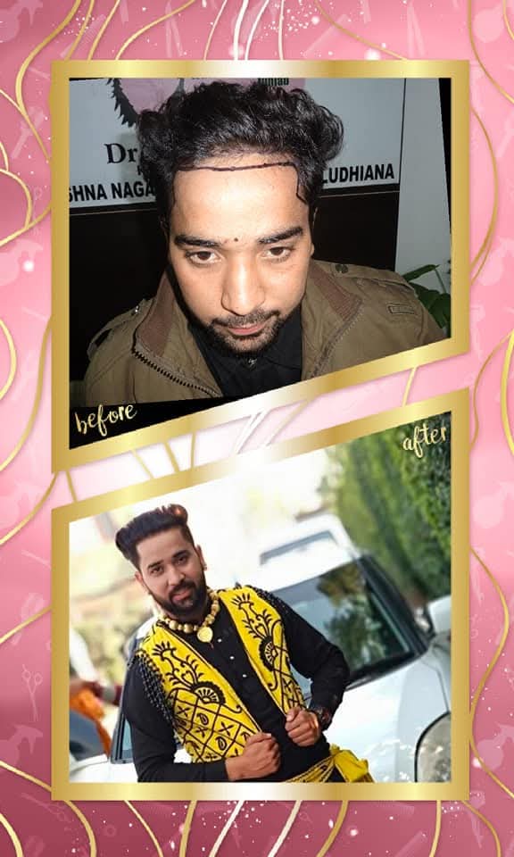 Before and after result of a male hair transplant from Ludhiana, Punjab. The 'before' shows the patient with the new hairline drawn on his forehead, and the 'after' shows the successful, dense hair growth and a complete cosmetic transformation.