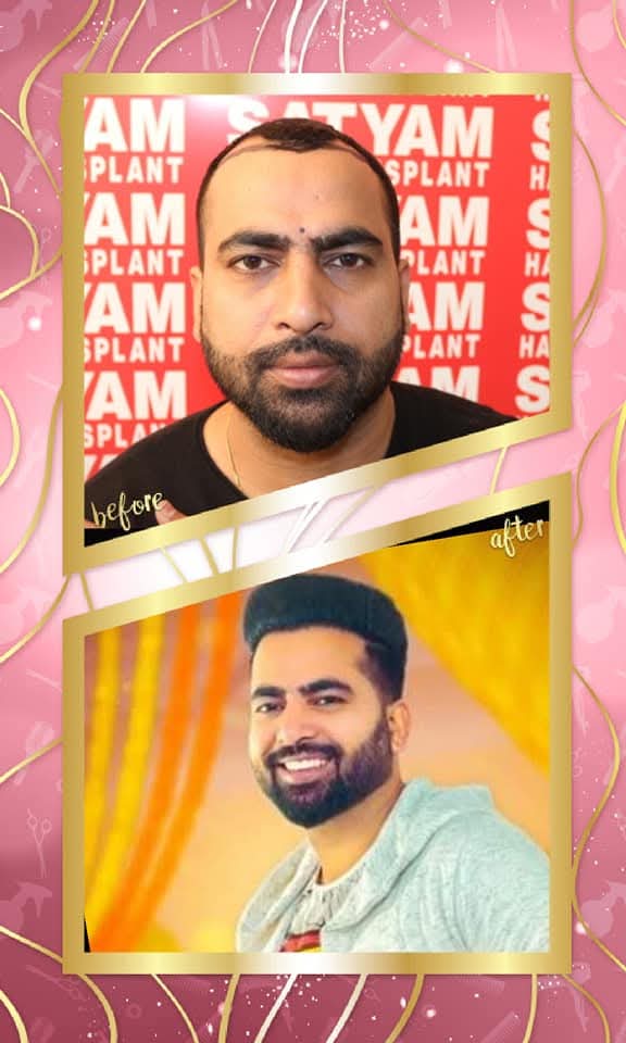 Before and after result of a successful hair transplant on a male patient from Satyam Hair Transplant Centre, Punjab, showing a completely restored hairline and dense hair growth.