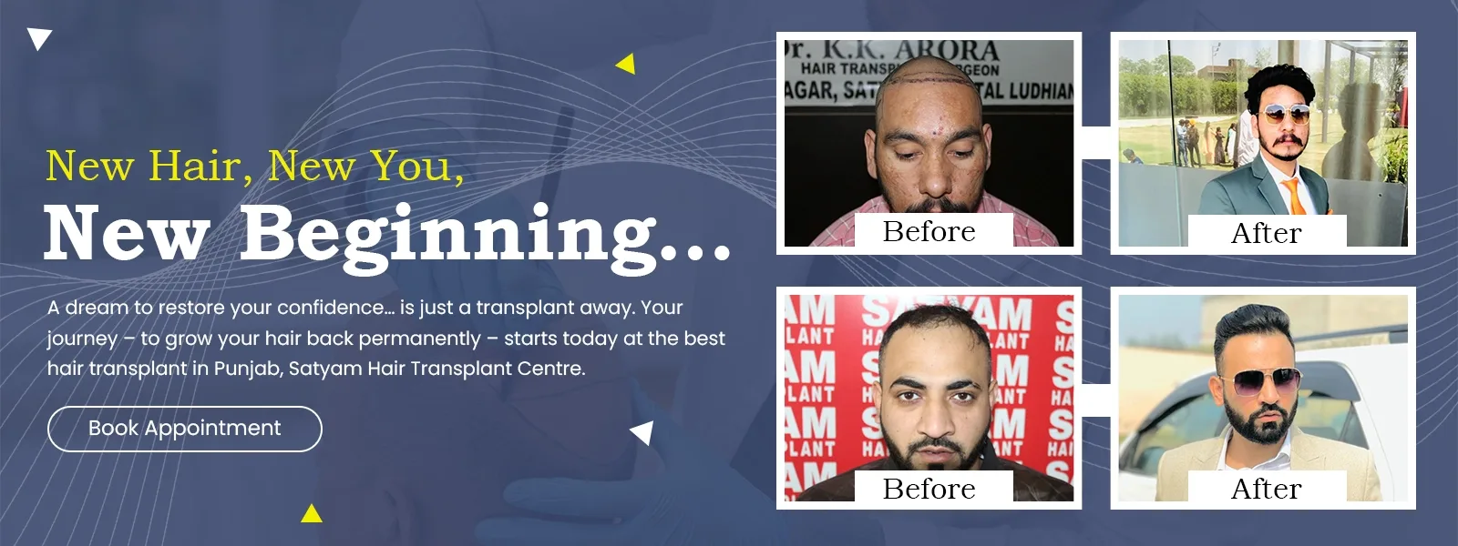 hair transplant before and after result (1)