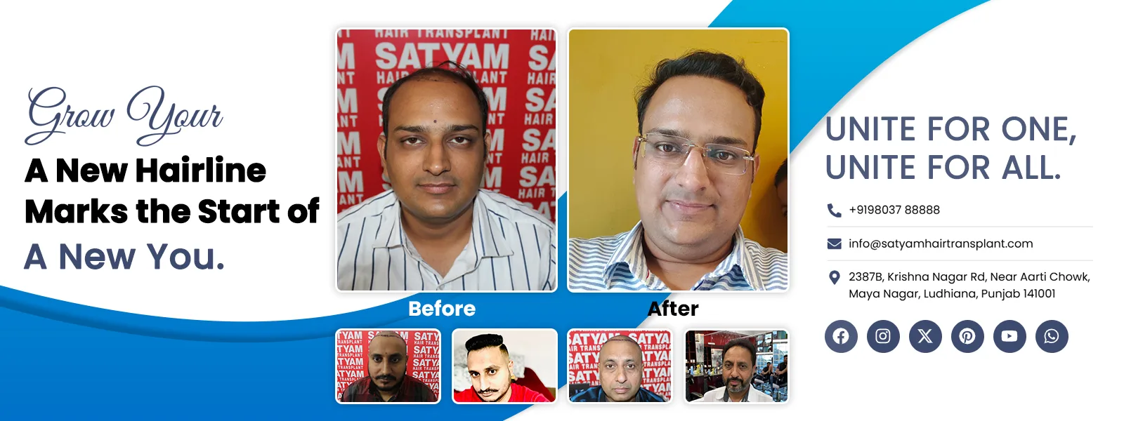 hair transplant before and after result photo punjab