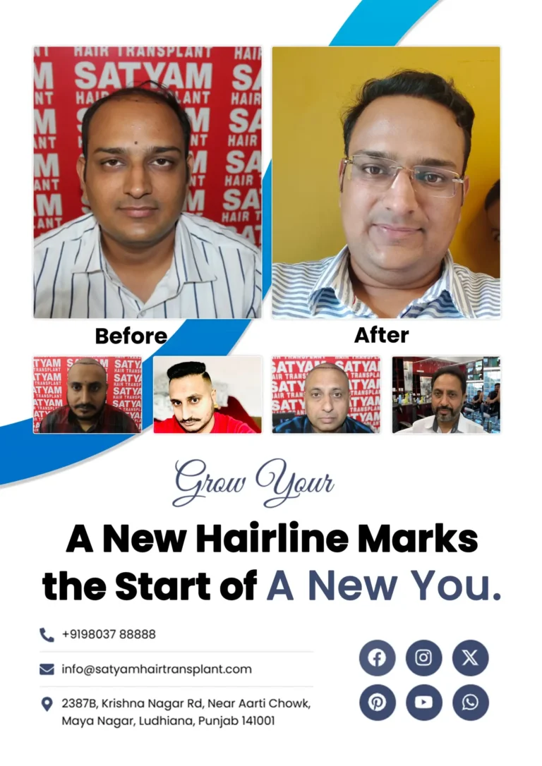 hair transplant results photos punjab (1)
